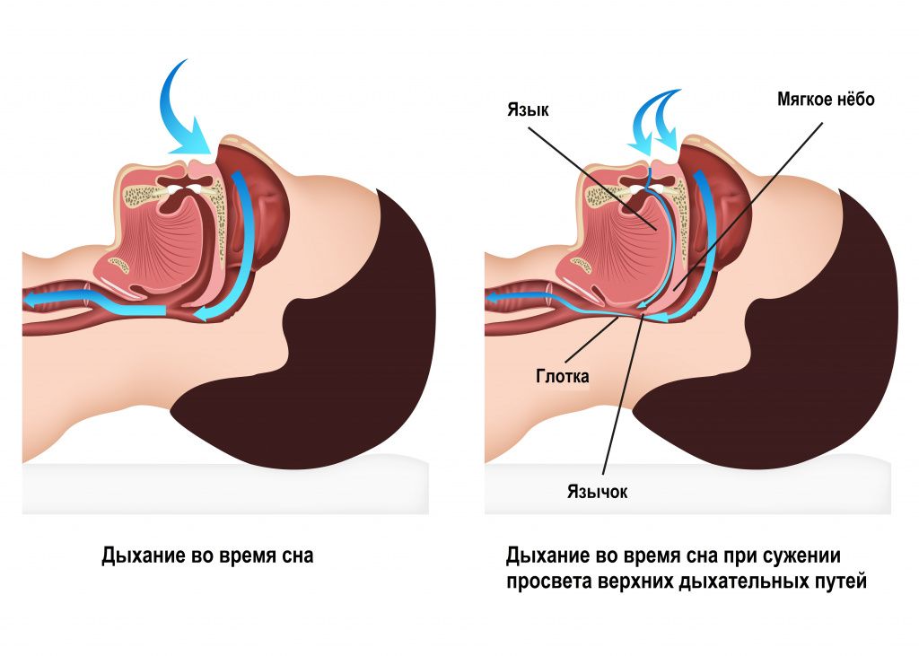 Современное амбулаторное хирургическое лечение храпа в НТМЦ! Современное амбулаторное хирургическое лечение храпа в НТМЦ!