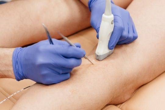 Минифлебэктомия Минифлебэктомия