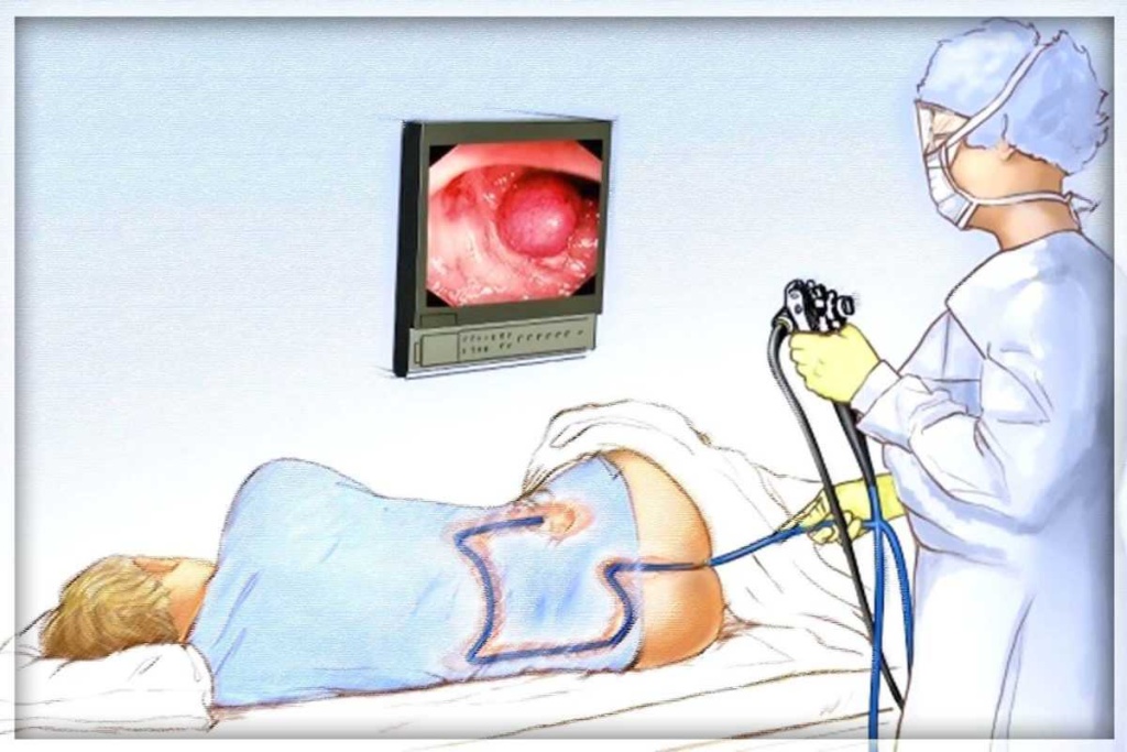 Колоноскопия 2.jpeg